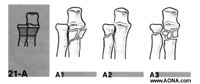 extra articular fractures