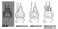 Extra-articular fracture, simple