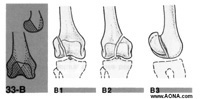 Partial articular fracture